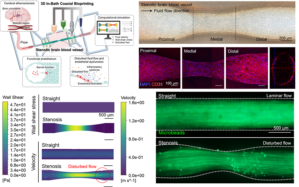 'Embedded 3D-Coaxial Bioprinting of Stenotic Brain Vessels with a Mechanically Enhanced Extracellular Matrix Bioink for Investigating Hemodynamic Force-Induced Endothelial Responses'
